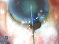 Iris Prolapse Phaco 3.1 Complications Iris Prolapse Phaco 3.1 Complications