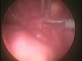Paraovarian cysts torsion