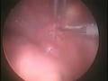 Paraovarian cysts torsion