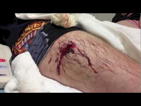 how to treat knife cut
