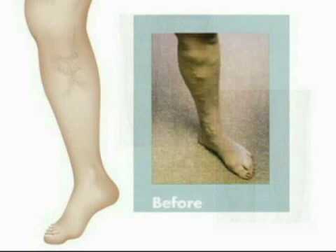 how to repair varicose veins