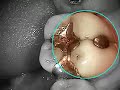 Dr. Fox - Root Canal Dr. Fox - Root Canal