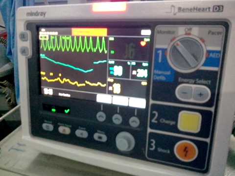 how to treat runs of v tach