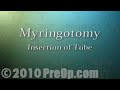 Myringotomy Insertion of Tube PreOp® Patient Education Feature