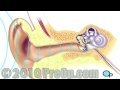 Myringotomy Insertion of Tube PreOp® Patient Education Feature
