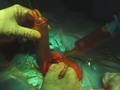 Gerard D. Henry performing Penile Prosthesis Surgery Part 2