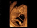 AMAZING Jumping Baby Ultrasound, 14 weeks + 4 days, You Can See the Gender!