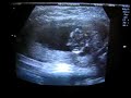 Baby Ultrasound 12 weeks 6 days