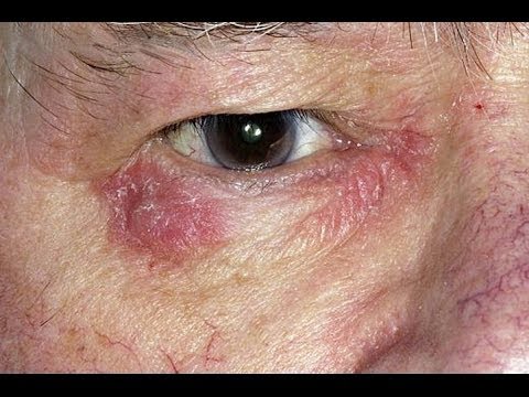 how to treat eye eczema