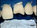 CeramX duo restauraci�n Clase IV Dr P.Colon /1