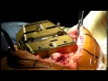Zimmer PSI Knee Replacement by Alan S. Nasar ...