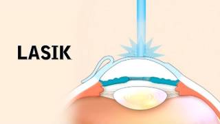 LASIK Surgery and its Risks