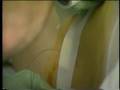 Epidural Placement