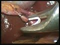 Laparoscopic Cholecystectomy Cholecystectomy