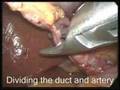 Laparoscopic Cholecystectomy