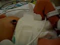 Johnny the premie in the NICU Johnny the premie in the NICU