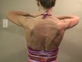 Damaged Long Thoracic Nerve - Winging Scapula