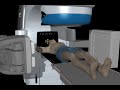 Prostate Cancer Treatement with Radiation Prostate Cancer Treatement with Radiation