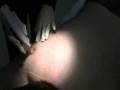 Laser Hair Removal at Ideal Image w/ Jeff