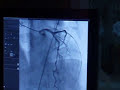 Coronary Angiography