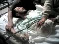 Alcohol Withdrawal Seizure, Delirium Tremens