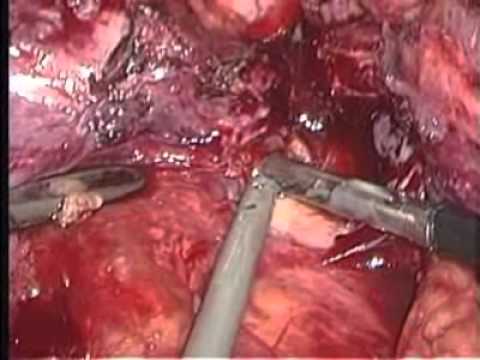 how to drain psoas abscess