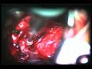 bilateral decompression bilateral decompression