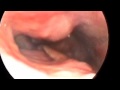 Endoscopic Look at Aberrant Carotid Artery Endoscopic Look at Aberrant Carotid Artery