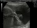 Edição da ultra-sonografia de Maria Eduarda em 07.03.08