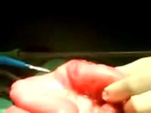how to get rid of worms inside u