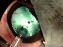 Cirurgia de Catarata através de Faco com implante de LIO dobrável em cães Cirurgia de Catarata através de Faco com implante de LIO dobrável em cães
