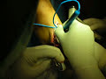 Osteotom�a de t�bia y peron�