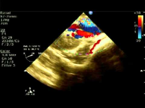 how to locate the aorta