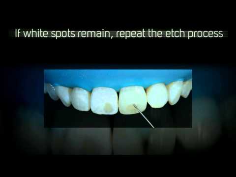 how to treat iv infiltration sites