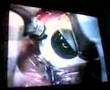 My LASIK surgery