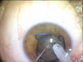 videos de MST Malyugin Ring using an injector