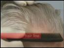 Hair Transplant Results/Norwood 5/3000 Grafts