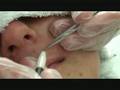 Permanente Haarentfernung durch Elektro-Epilation