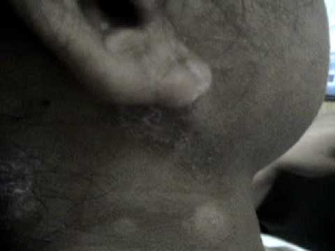 how to treat koebner phenomenon