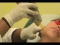 Laser Hair Removal-Upper lip and Chin-Dr. Badia