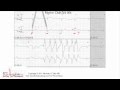 ECG Interpretation Basic Level - Part 6 ECG Interpretation Basic Level - Part 6