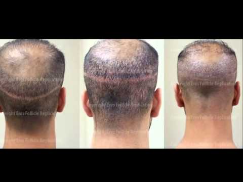 how to cover hair transplant scar