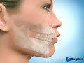 Removal of Upper 1st Premolars&Lower 2nd Premolars to Reduce Lip Fullness