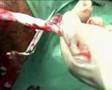Recolha de Sangue do Cordão Umbilical 