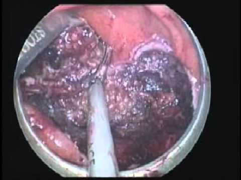 rectal