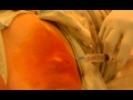 Barely Numb Cyst/Abscess Extraction PAINFUL