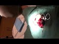 Cyst Surgically Removed HD