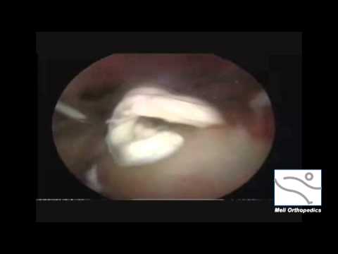 how to dissolve calcium deposits in the joints
