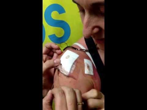 how to remove on q pain pump