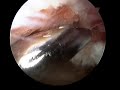 Arthroscopic Subacromial Decompression